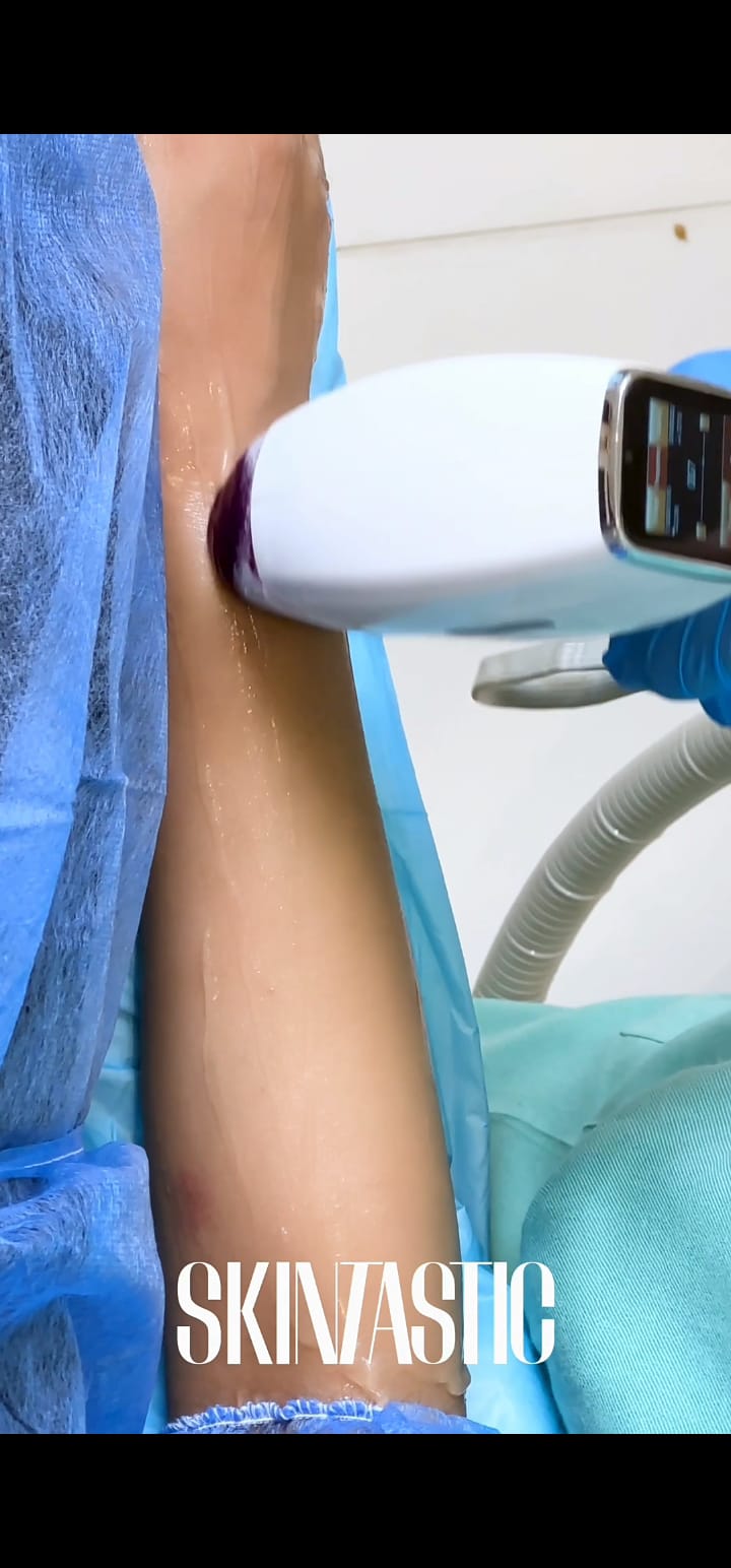 Arms and Legs Laser Treatment Process at SkinTastic