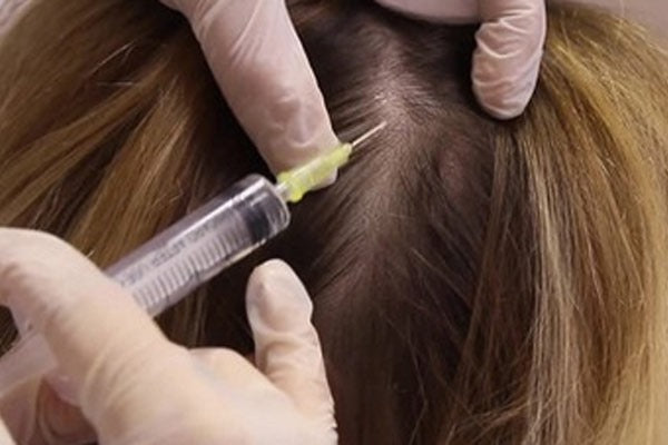 Exosome Stem Cells Therapy Hair Loss treatment at SkinTastic Sargodha