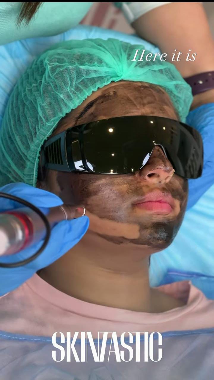 Gel Peel at Skintastic Aesthetic Clinic Sargodha