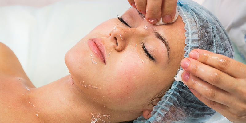 Tca Peel treatment at Skintastic Sargodha - 1