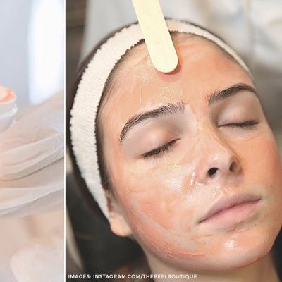 Tca Peel treatment at Skintastic Sargodha - 2