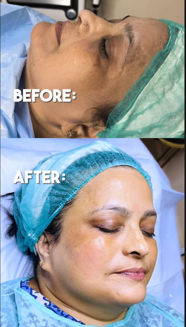 ST Diamond Shine Treatment at SkinTastic Sargodha