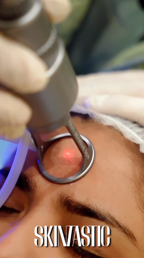 Acne Scar Removal View 3