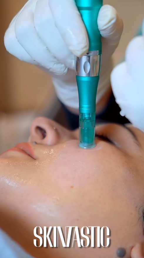 Acne Scar Removal at SkinTastic Sargodha