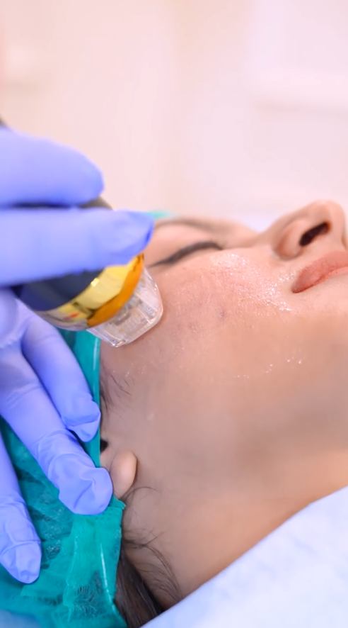 Acne Scar Removal View 2