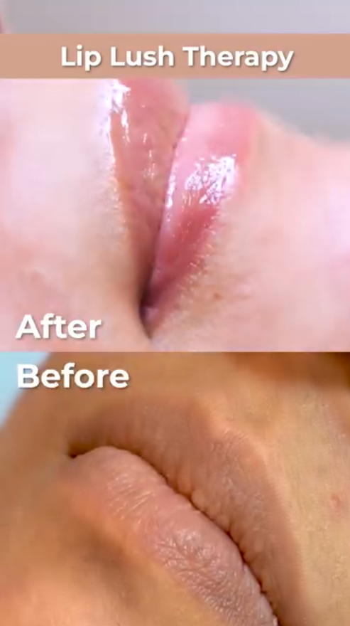 lip lush therapy