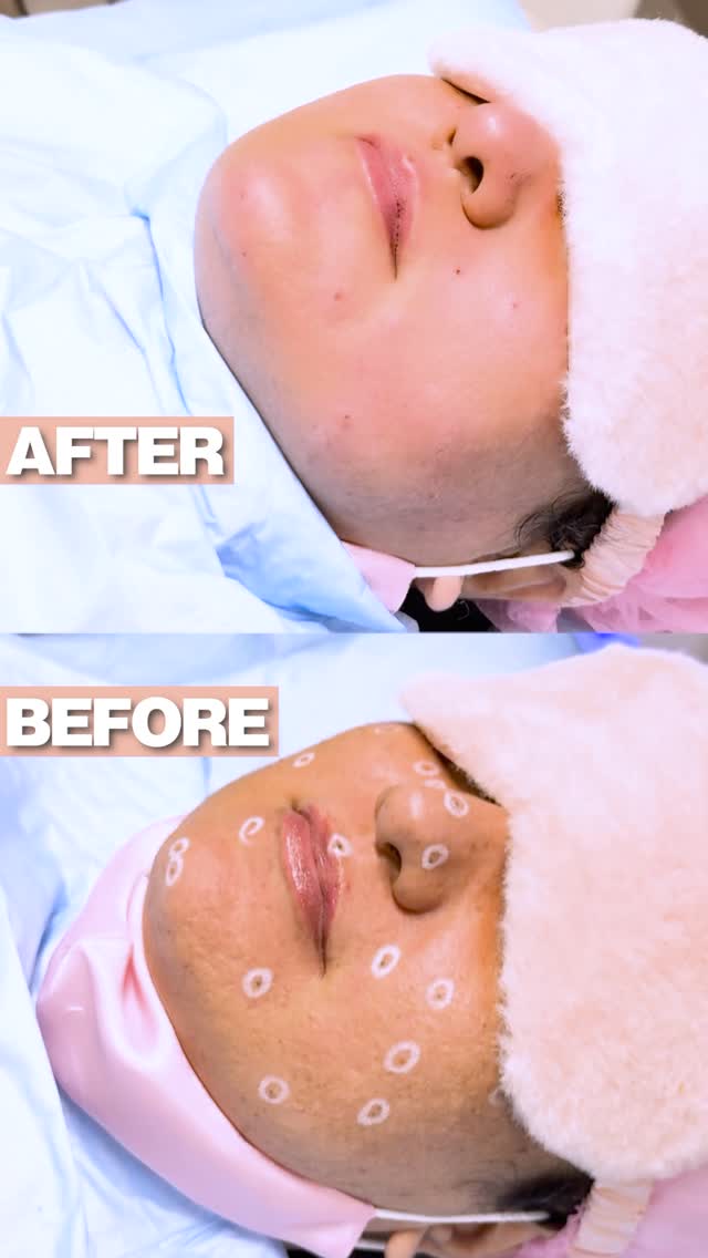 Mole Removal at Skintastic Aesthetic Clinic Sargodha