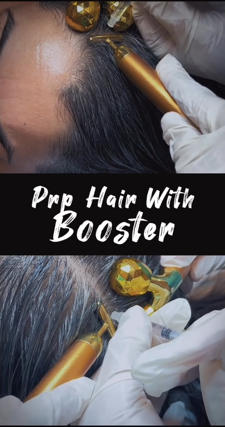 PRP for Hair Loss at Skintastic Aesthetic Clinic Sargodha