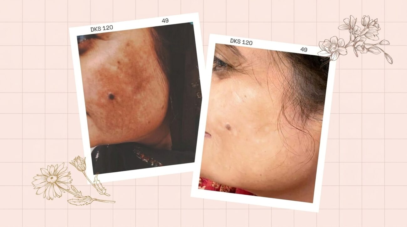 Hyperpigmentation Causes & Modern Solutions in Pakistan