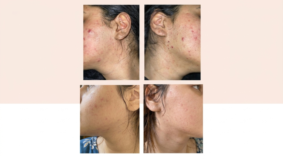 Why Natural Results Are the Biggest Trend in Aesthetics