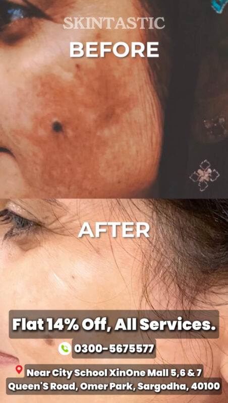 Perioral Pigmentation