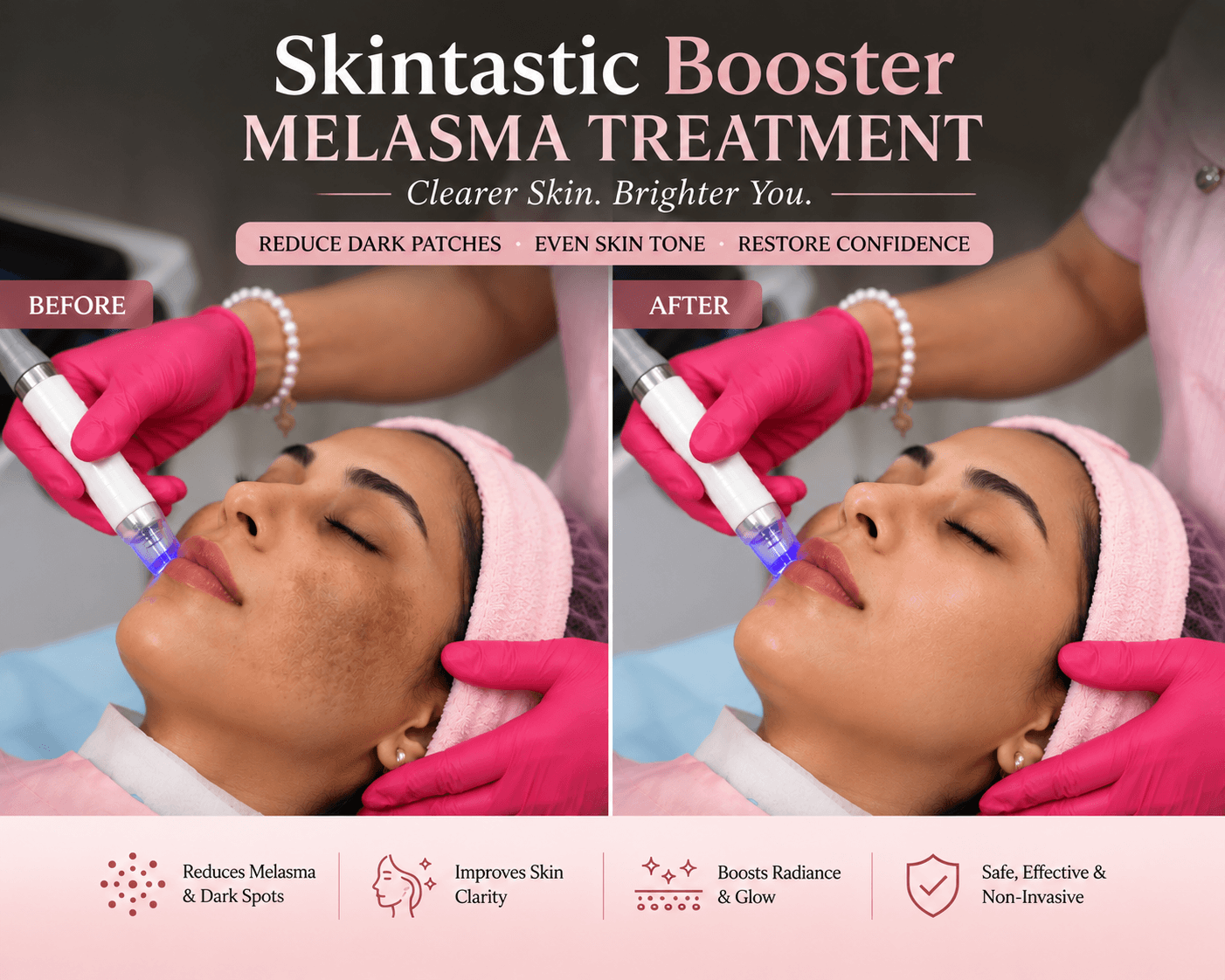 Skin Boosters for Melasma