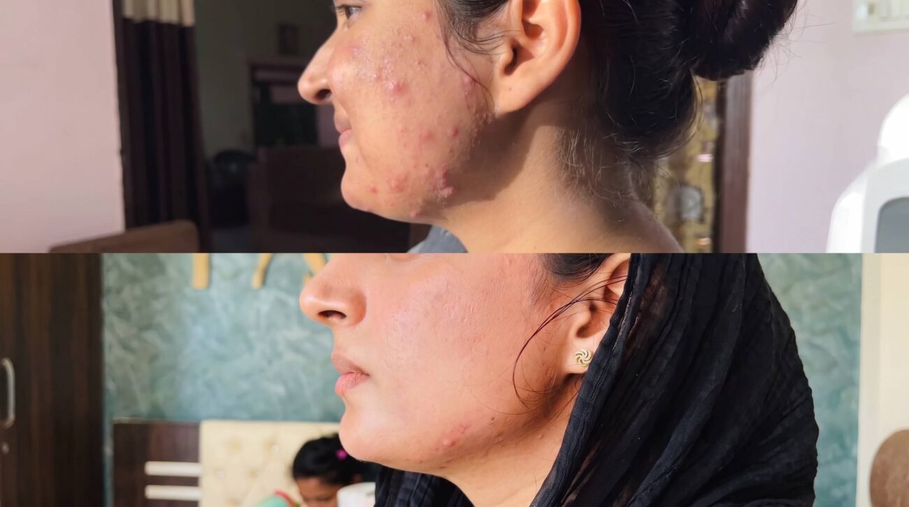 Skin Barrier Damage Signs, Causes & Treatment Options