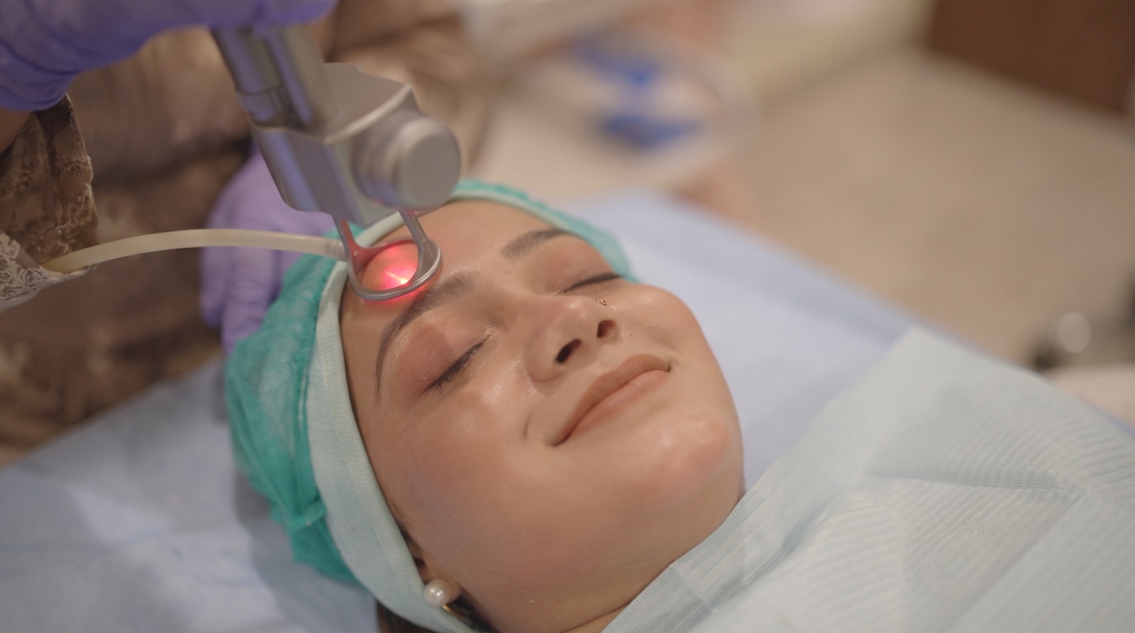 CO2 fractional laser acne scar resurfacing in Sargodha