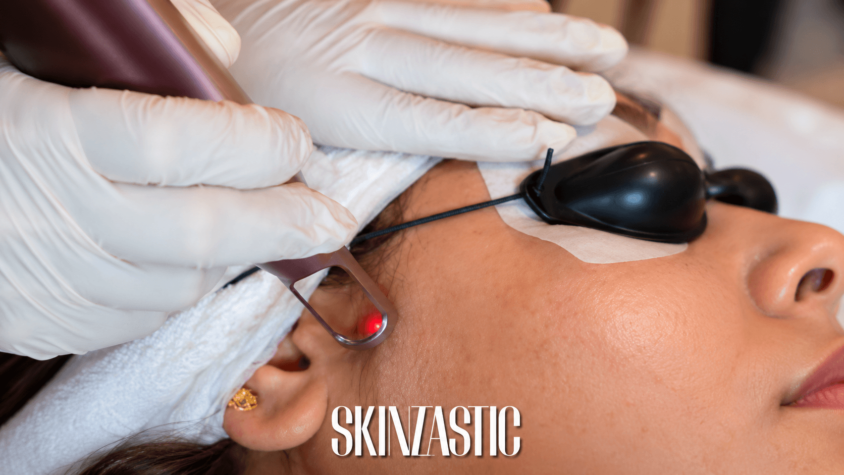 Picosecond laser treatment for melasma and pigmentation
